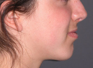 chin surgery implant after photo patient 1